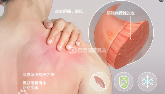 肌筋膜炎疼痛反复发作？试试冲击波治疗，临床验证疗效显著